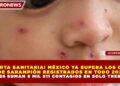 ¡ALERTA SANITARIA! MÉXICO YA SUPERA LOS CASOS DE SARAMPIÓN REGISTRADOS EN TODO 2025; EN 2026 SUMAN 6 MIL 511 CONTAGIOS EN SOLO TRES MESES