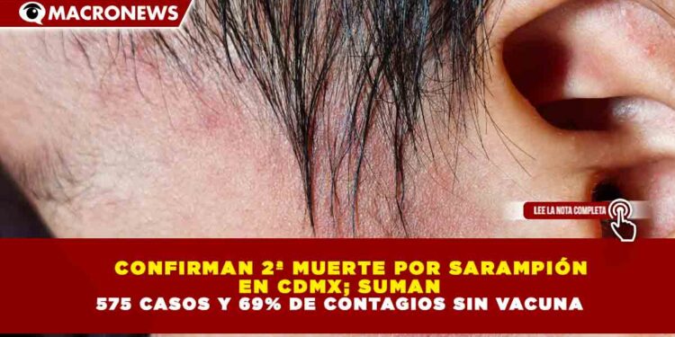 CONFIRMAN 2ª MUERTE POR SARAMPIÓN EN CDMX; SUMAN 575 CASOS Y 69% DE CONTAGIOS SIN VACUNA