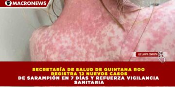 SECRETARÍA DE SALUD DE QUINTANA ROO REGISTRA 12 NUEVOS CASOS DE SARAMPIÓN EN 7 DÍAS Y REFUERZA VIGILANCIA SANITARIA